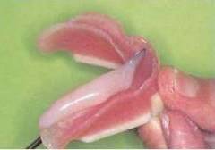 治療用義歯 治療用義歯