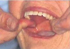 歯を抜いた箇所の傷の回復を待ちます 歯を抜いた箇所の傷の回復を待ちます