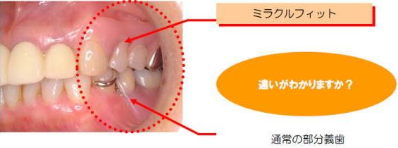 ミラクルフィットと通常の部分義歯の違い ミラクルフィットと通常の部分義歯の違い