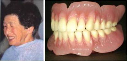 完成義歯 完成義歯